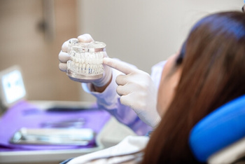 Stages of Dental Implants explanation