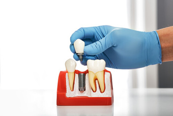 cheap dental implants reasons