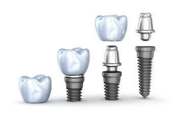 Before and After Dental Implants parts