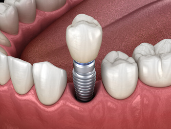 Before and After Dental Implants procedure