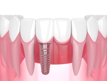 Types of Dental Implants kinds