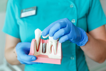 Dental Implant Procedure explanation