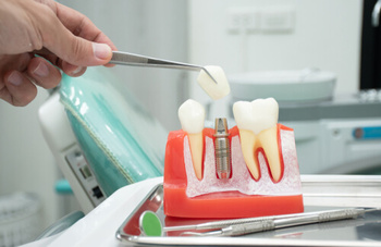 Dental Implant Thailand procedure