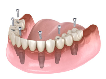 Full Mouth Dental Implants Cost Australia illustration
