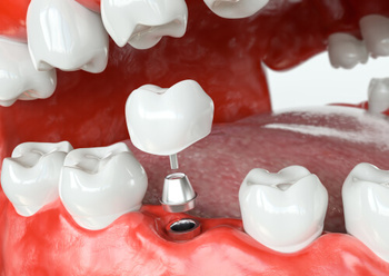 bali dental implant cost