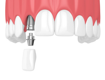 bali dental implant procedure