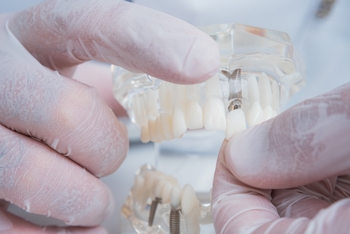 out of the country worth dental implants brisbane