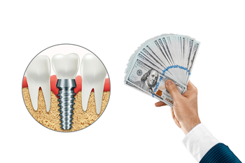 
tooth implant expenses overseas brisbane
