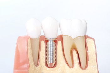 
value foreign dental implants brisbane
